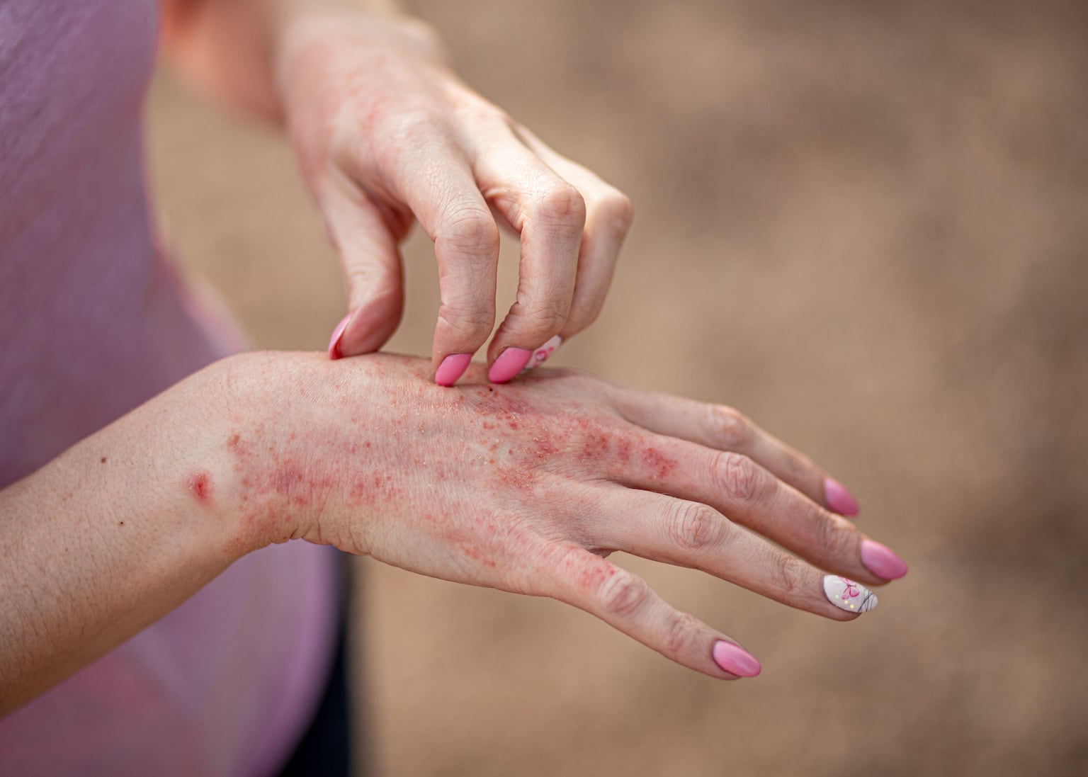 NHS rollout of new eczema cream could benefit more than 62,000 people in England